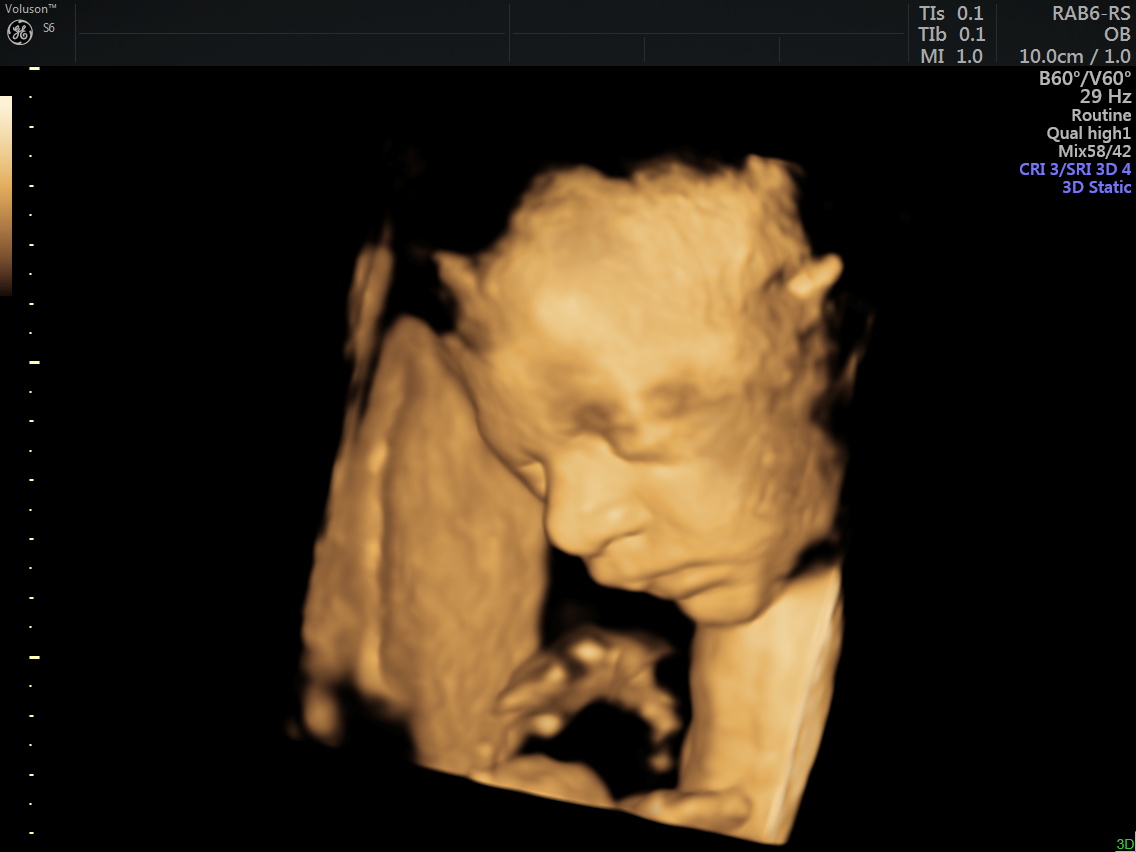 Midyat 4 Boyutlu Ayrıntılı Ultrason