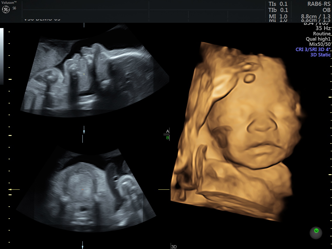midyatta ultrasyon &ccedil;ekim yeri